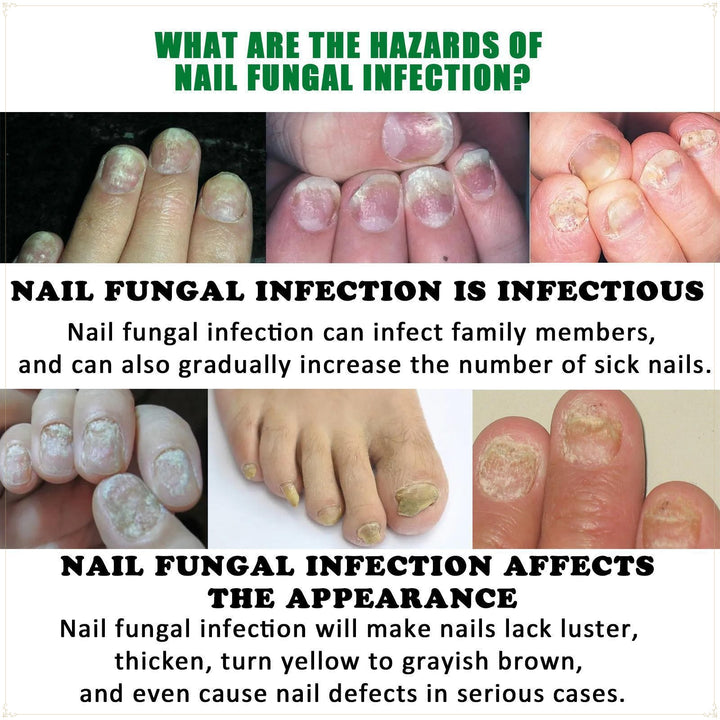 Antifungal nail serum